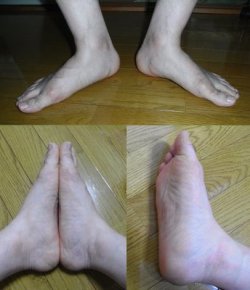 flat feet pain